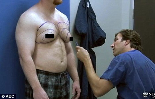Năm 1994, Erik Holler, người Mỹ phát hiện ra mình có cái bướu nhỏ ở đầu ngực bên trái. Dần dần,  khối u này phát triển nhanh, khiến ngực của Erik bỗng to dần như bộ ngực như của phụ nữ. 


