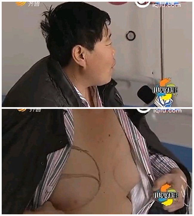 Do uống 1 loại thuốc chữa vô sinh trong nhiều năm, người đàn ông tên họ Tiết, 45 tuổi, ở Hà Bắc, Trung Quốc đã bị rối loạn nội tiết, dẫn đến bộ ngực phát triển lớn dần như phụ nữ.




