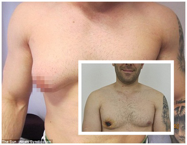 Farshad Hashemzadeh, 28 tuổi, người Anh mắc hội chứng tuyến vú phát triển ở nam giới do rối loạn hoóc môn gây ra. 

