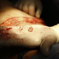 Sức khỏe đời sống - Vào TP.HCM bơm silicon độn mông, ra Hà Nội xử lý hậu quả