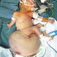 Sức khỏe đời sống - Cắt khối u quái nặng 2,6 kg cho trẻ sơ sinh