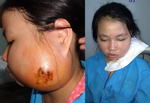 Cắt bỏ thành công khối u gây biến dạng khuôn mặt bé gái - 1