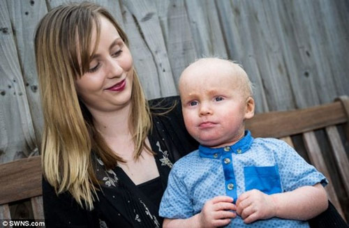 Bé trai không thể chớp mắt vì bị bệnh vảy cá - 2