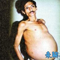 Phi thường - kỳ quặc - "Mang thai" anh em song sinh 36 năm