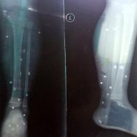 Pháp luật - Côn đồ nổ súng, bé 4 tuổi "dính" 15 viên đạn