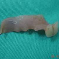 Sức khỏe đời sống - Hóc răng giả, hóc thịt: Nỗi ám ảnh của bác sĩ nội soi