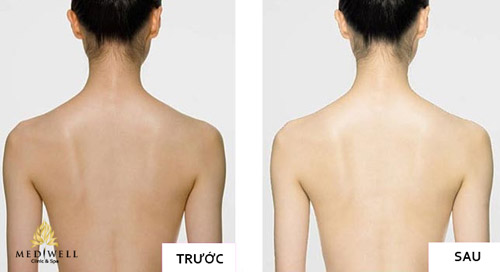 Trắng không tì vết với liệu pháp Bellena Nhật Bản - 1