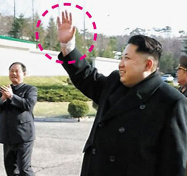 Rộ tin ông Kim Jong-un bị chấn thương cổ tay - 1