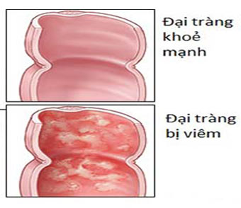 Viêm đại tràng và cách điều trị hiệu quả nhất? - 1