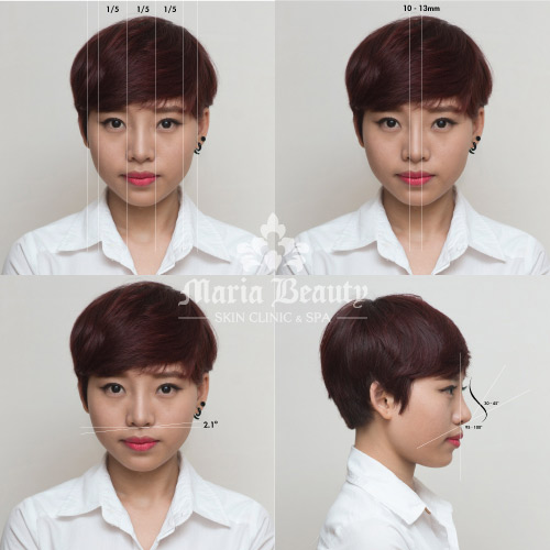 Mũi đẹp chuẩn Hàn chỉ sau 7 ngày nghỉ lễ - 1