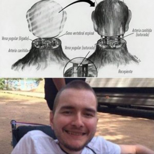 Sốc: Tình nguyện chặt đầu để được ghép đầu - 3