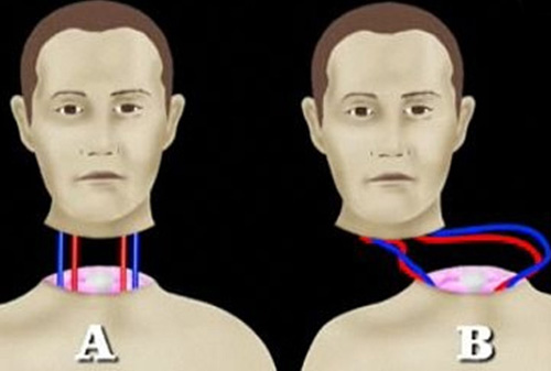 Sốc: Tình nguyện chặt đầu để được ghép đầu - 4