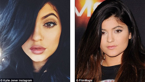 Em gái 17 tuổi của Kim Kardashian thừa nhận bơm môi - 1