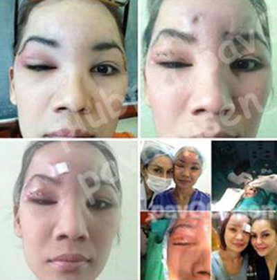 Cô gái Thái mù mắt sau khi trùng tu nhan sắc - 1