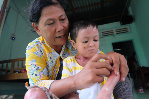 Thực hư vụ cháu bé bị đổ nước sôi vào người để ăn xin - 2