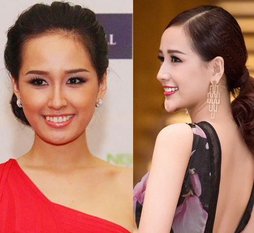 Hoài nghi trước cằm dài, nhọn bất thường của người đẹp Việt - 7