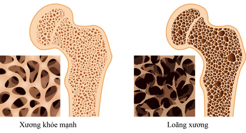 Bệnh loãng xương - sát thủ thầm lặng tuổi trung niên - 3