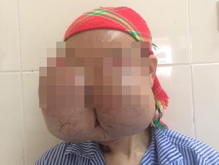 Cắt bỏ 2 khối u khổng lồ trên mặt người phụ nữ - 1