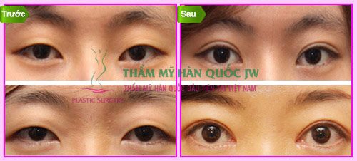 Phẫu thuật nâng cơ đuôi mắt điều trị sụp mi - 1