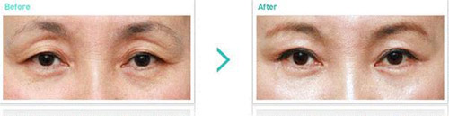 Giải pháp nào cho tình trạng hốc mắt sâu? - 2