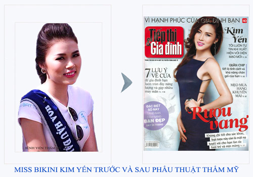 Phẫu thuật nâng mũi đẹp ở Bệnh viện Việt Mỹ - 5
