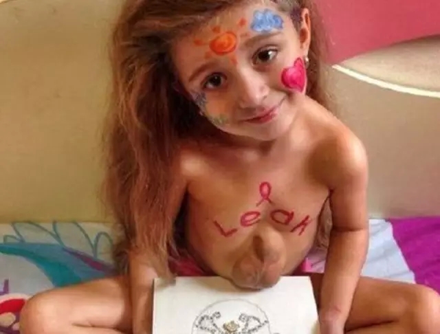 Kinh ngạc bé 5 tuổi có trái tim ngoài lồng ngực - 4