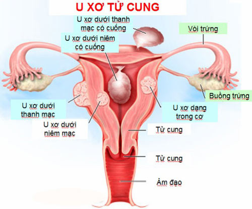 Bác sỹ tư vấn hiếm muộn do u xơ tử cung - 1