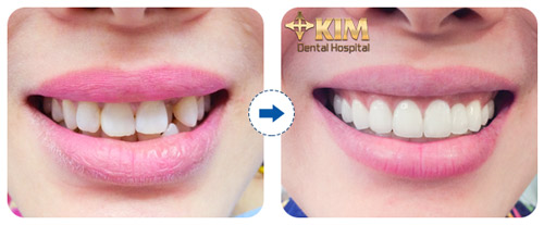 Sửa răng sứ đã bọc nhưng không đẹp - 3
