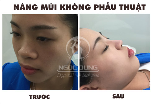 Giải mã ‘cơn sốt’ nâng mũi không phẫu thuật - 2