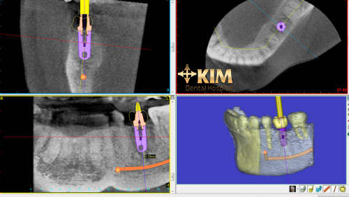 Cấy răng Implant, ghép xương, ghép nướu không đau - 4