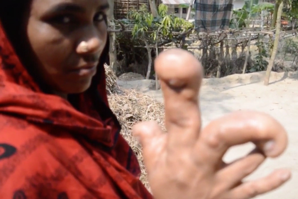 Bàn tay khổng lồ dị dạng của người phụ nữ Bangladesh - 2