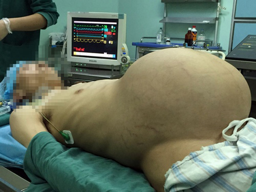 Trung Quốc: Người đàn ông mang khối u cứ ngỡ mình mang bầu - 1