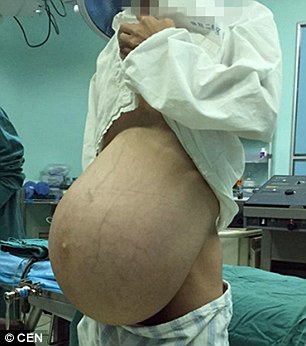 Kinh hoàng người đàn ông "mang thai" khối u 15kg suốt 10 năm - 1