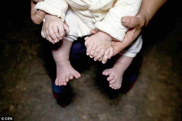 Em bé có tới 31 ngón tay, chân ở Trung Quốc - 1