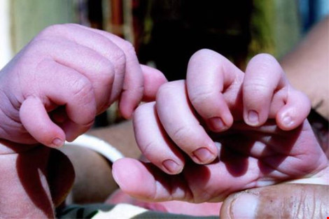 Kỳ lạ bé sơ sinh có 31 ngón tay và ngón chân - 1