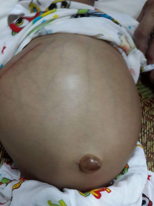 Đau đớn bé trai 2 tháng tuổi bụng to như chiếc trống - 2