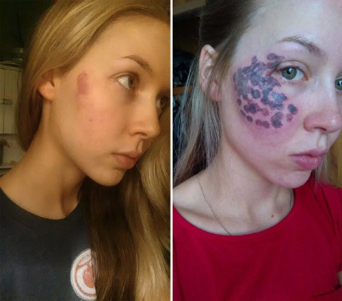 Thiếu nữ Mỹ bị phá hủy khuôn mặt vì tẩy vết bớt - 1