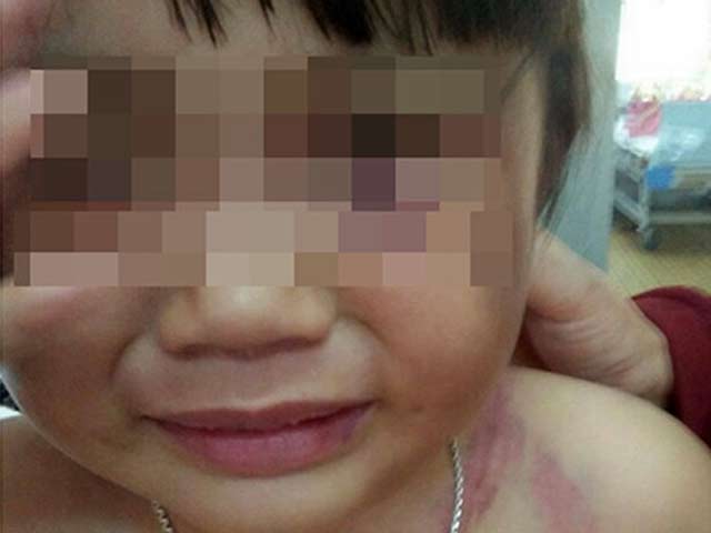 Bé gái 3 tuổi bị đánh bầm tím, cha dượng bị bắt - 1