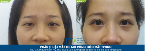 Phẫu thuật mắt to - Xóa tan nỗi lo thẩm mỹ mắt hỏng - 2