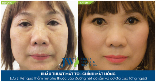 Phẫu thuật mắt to - Xóa tan nỗi lo thẩm mỹ mắt hỏng - 3