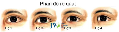 Phẫu thuật mắt to - Xóa tan nỗi lo thẩm mỹ mắt hỏng - 4