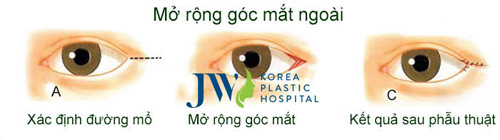Phẫu thuật mắt to - Xóa tan nỗi lo thẩm mỹ mắt hỏng - 7