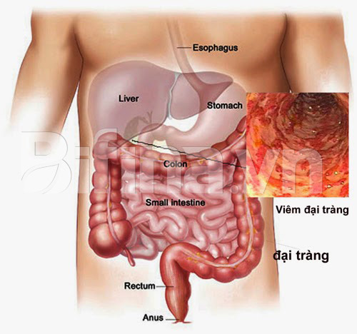 3 sai lầm khiến người viêm đại tràng không bao giờ thoát khỏi - 1