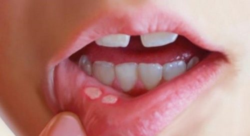 Cách chữa viêm loét miệng đơn giản, an toàn tại nhà - 1