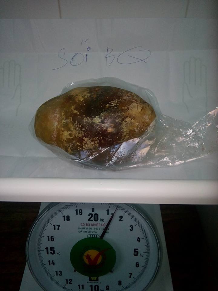 Sỏi bàng quang “khủng” trong bụng bệnh nhân hơn 10 năm - 2