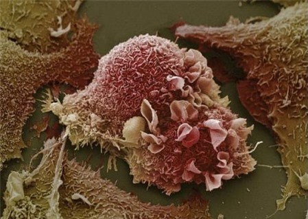 Sự phá huỷ tàn khốc của tế bào ung thư - 1