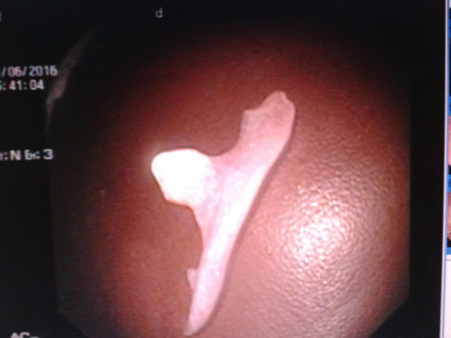 Nuốt cung hàm răng giả, nữ bệnh nhân suýt thủng dạ dày - 1