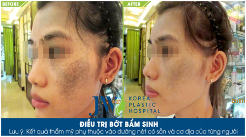 Bí quyết chữa khỏi bớt chàm bẩm sinh - 1