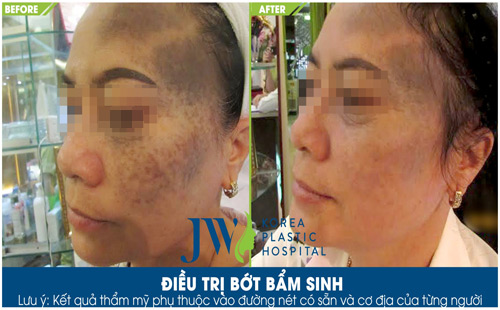 Bí quyết chữa khỏi bớt chàm bẩm sinh - 2