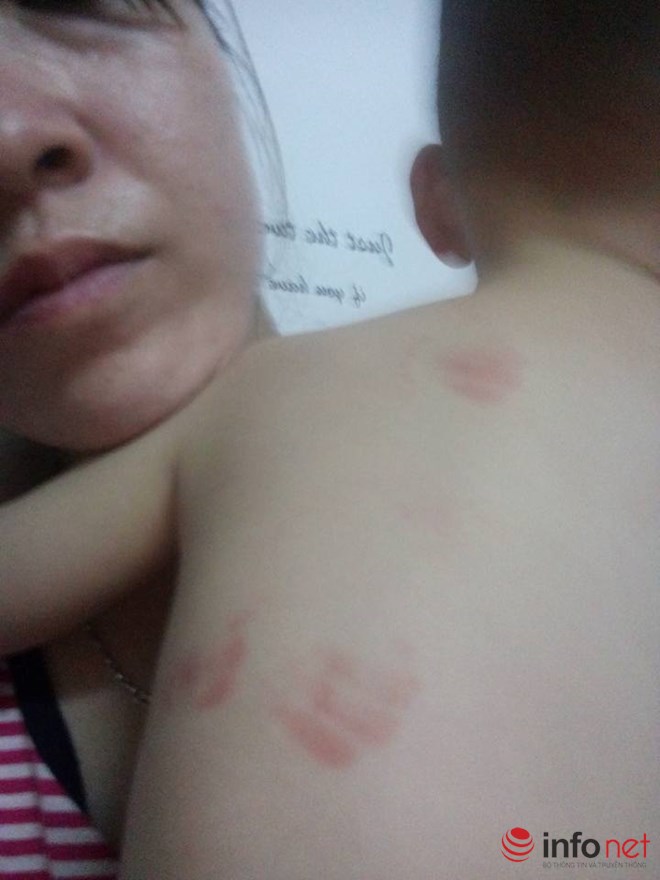 Hà Nội: Bé 20 tháng tuổi bị cắn tím người khi ở trường mầm non về - 4